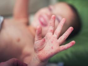 pieds mains bouche pieds mains bouche